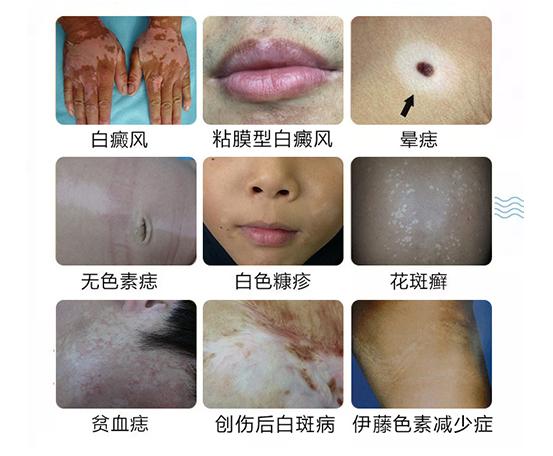 身上起小白点是什么原因怎么治,身上有一块白斑汗毛也是白的