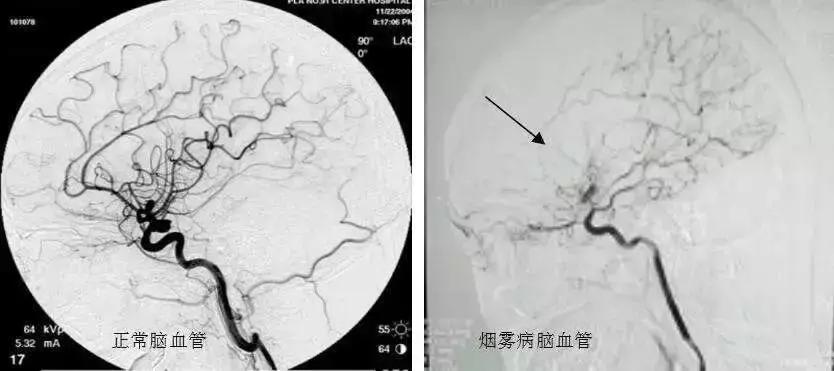 什么是烟雾病综合症,什么是烟雾病的诊断标准