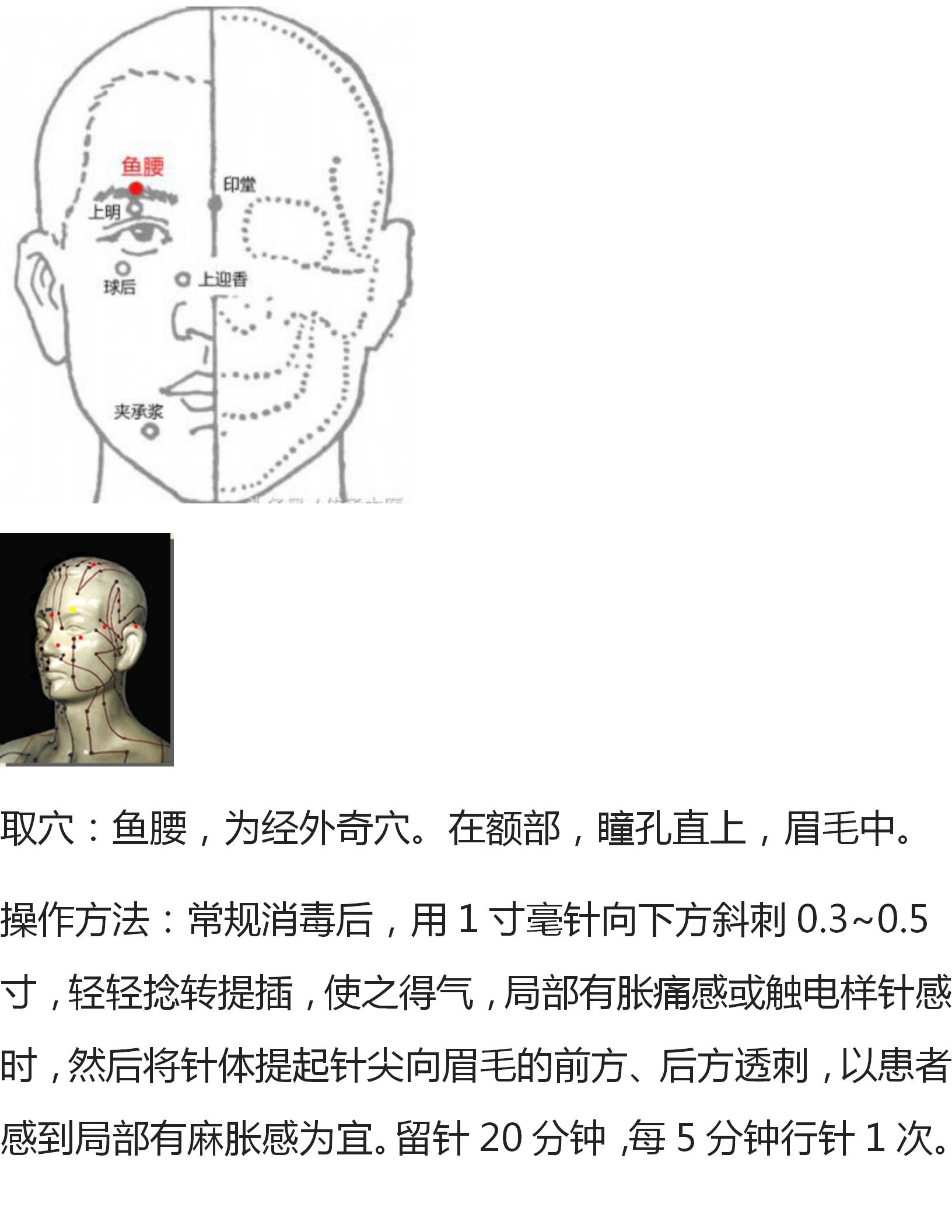 针灸治疗痛症大全,全身痛董氏奇穴针灸视频