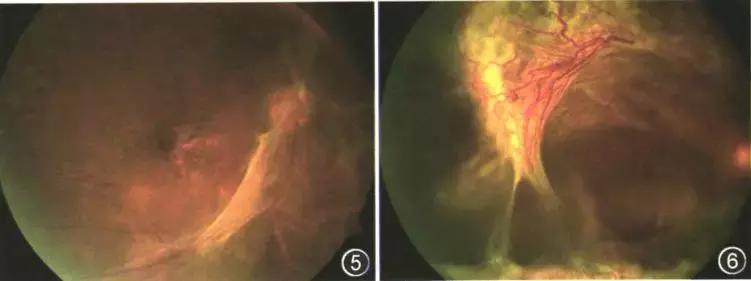糖尿病眼病能治好吗,糖尿病眼病能手术么