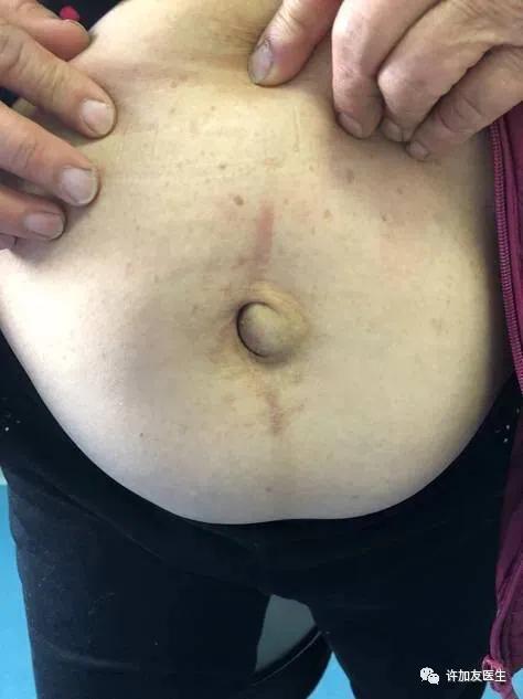 疝气婴儿肚脐眼图片,肚脐眼疝气能下去吗