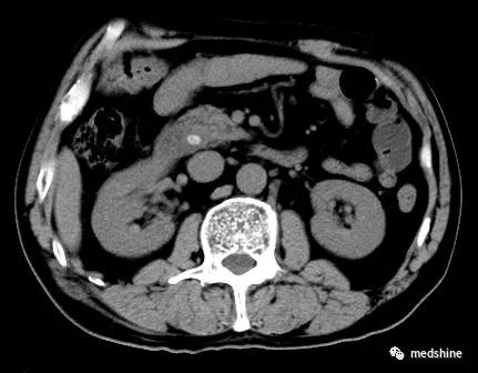 七十岁胆囊切除后遗症,20岁胆囊切除后遗症