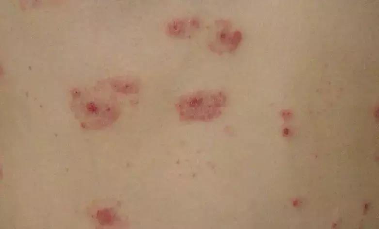 湿疹反复发作不妨试试这几个办法,湿疹总反复教你几招搞定它