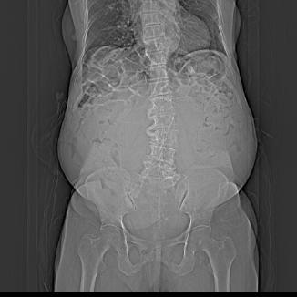 「勇闯禁区」95岁老奶奶腹胀如篮球，多科协作终克顽疾取巨瘤