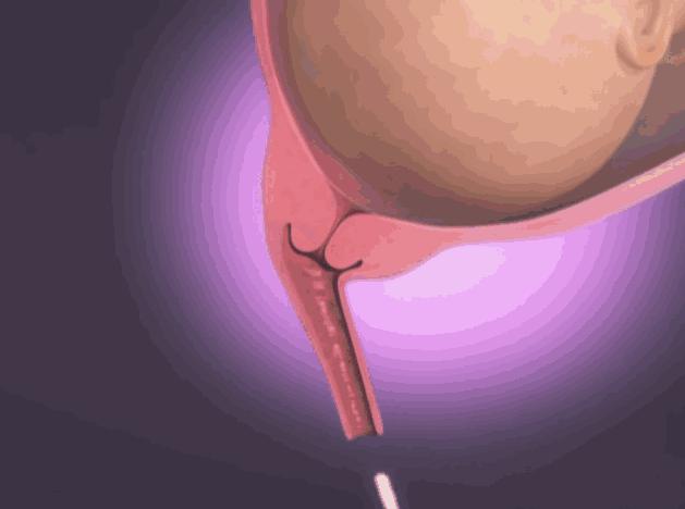 女人生孩子到底有多疼？