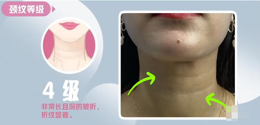 嗨体颈纹针使用方法,嗨体颈纹注射全过程