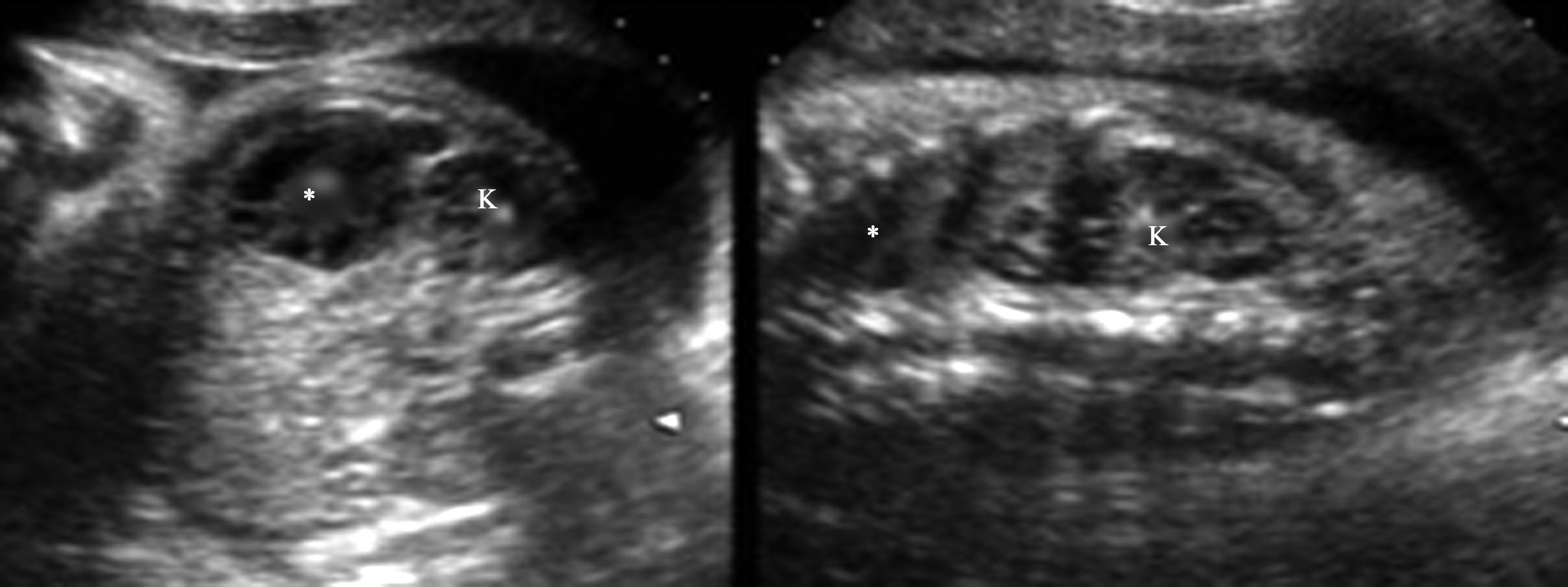 胎儿腹部可见6公分囊性包块,胎儿腹部有肿块怎么回事