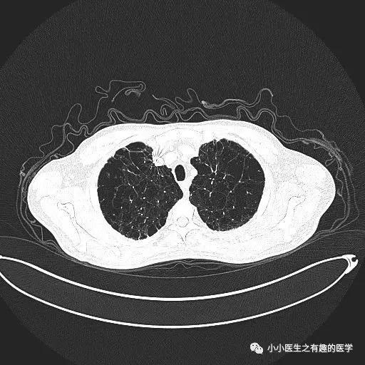 间质性肺炎CT诊断,间质性肺炎ct诊断报告