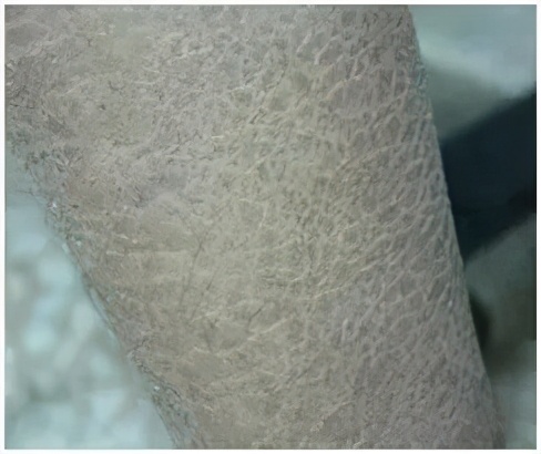 得了湿疹,得了湿疹身上的伤就没好过