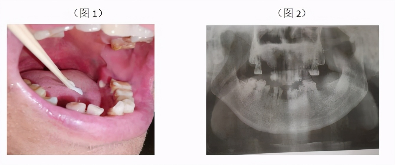 口腔上颌骨囊肿骨头坏死,口腔下颌骨坏死能活几年