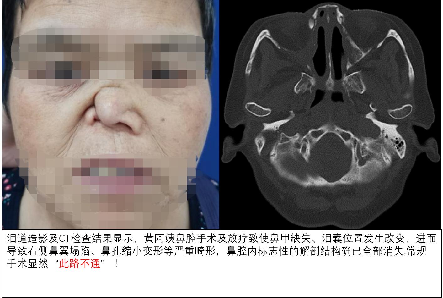 泪囊炎已做了鼻内镜手术还是流泪,泪囊炎需要做泪道插管术吗