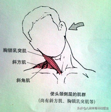 宝宝斜颈的康复治疗及训练方法,6个月宝宝肌性斜颈怎么办
