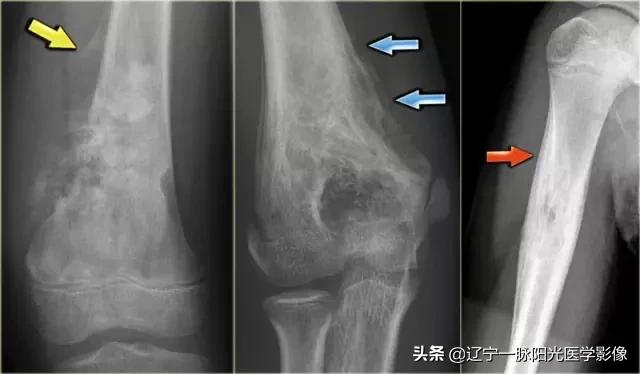 骨膜反应类型有哪几种,骨膜反应怎么快速恢复