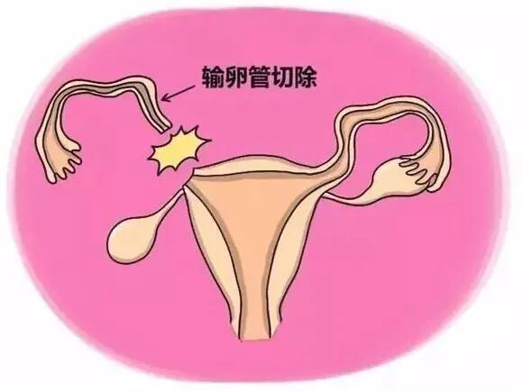 宫外孕早期保守治疗好还是手术好,怀孕初期预防宫外孕的运动锻炼