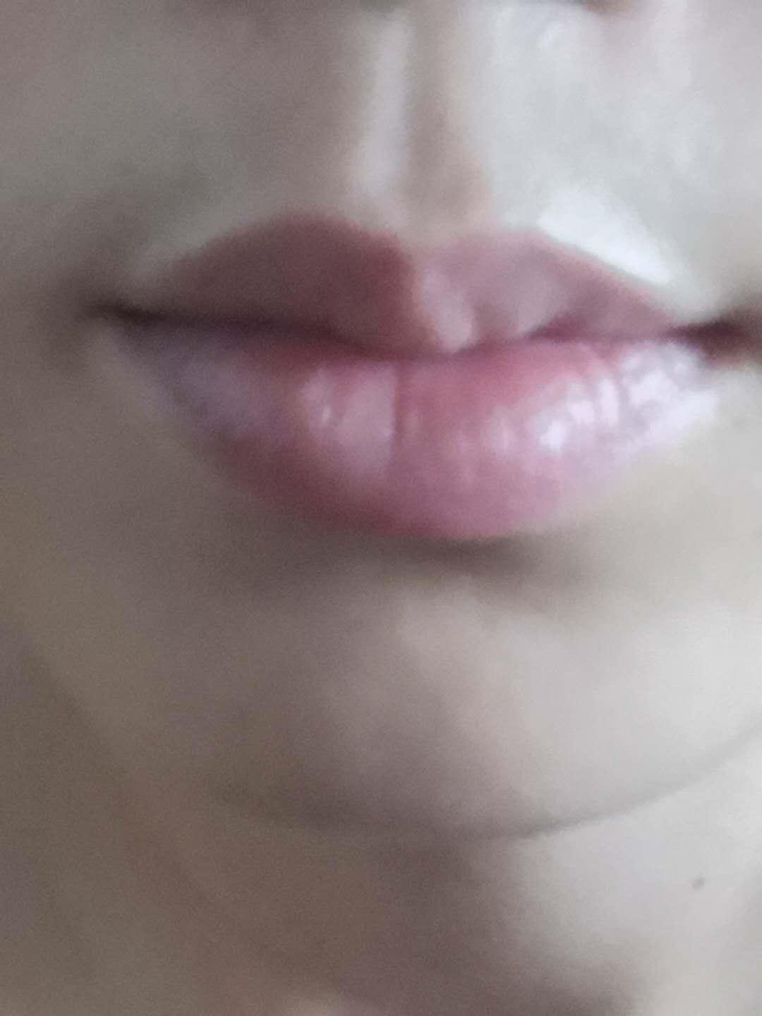 唇炎反复红肿发痒灼热怎么治疗,引起唇炎的原因