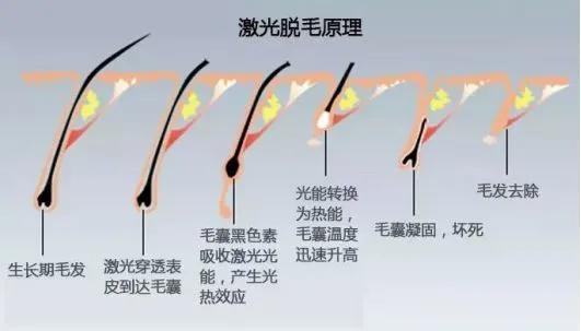 脱毛后总觉得冷飕飕的,脱毛后总觉得腋下粘粘的