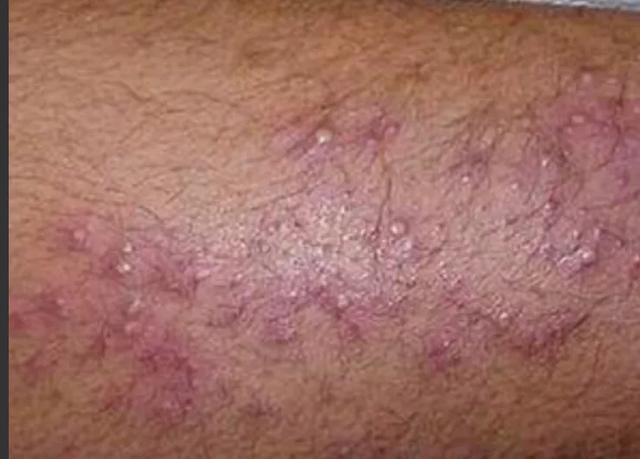 恐艾滋病的人出现疑似症状,恐艾患者自述皮疹