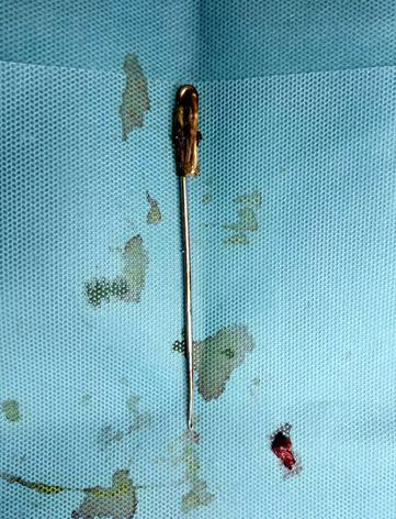 男子与妻子拌嘴一气之下吞16公分长针