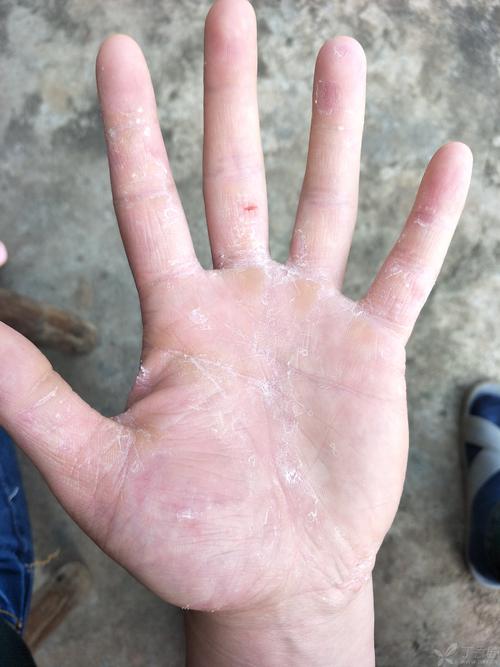 手脱皮好了又脱皮是什么原因,手脱皮是什么原因引起的怎么治疗