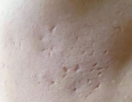 祛痘和祛痘印最有效的方法,祛痘印和祛痘坑哪个效果好