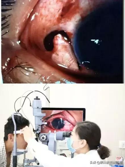 小伙被球击中眼睛,篮球砸到眼睛视力降落多久恢复
