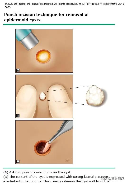 耳朵里面长了个肉疙瘩不疼严重吗,耳朵上长了个小疙瘩需要手术吗