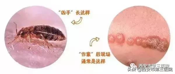 虫咬性皮炎很痒怎么治疗小偏方,恼人的皮炎怎么治