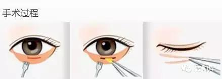 北大整形教授张宗学,张宗学博士微整形