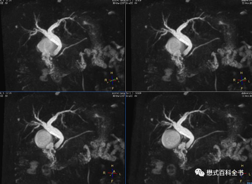 开展mrcp技术,mrcp检查操作流程