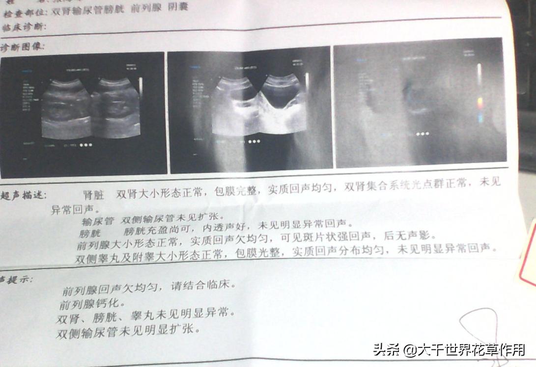 前列腺钙化灶是怎么产生的,前列腺钙化灶是怎么形成的严重吗