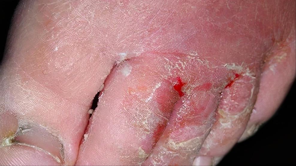 脚上干燥脱皮是真菌感染嘛,脚上因为真菌而开裂怎么办