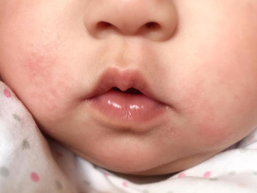 口水疹症状及治疗,婴儿出现口水疹怎么办