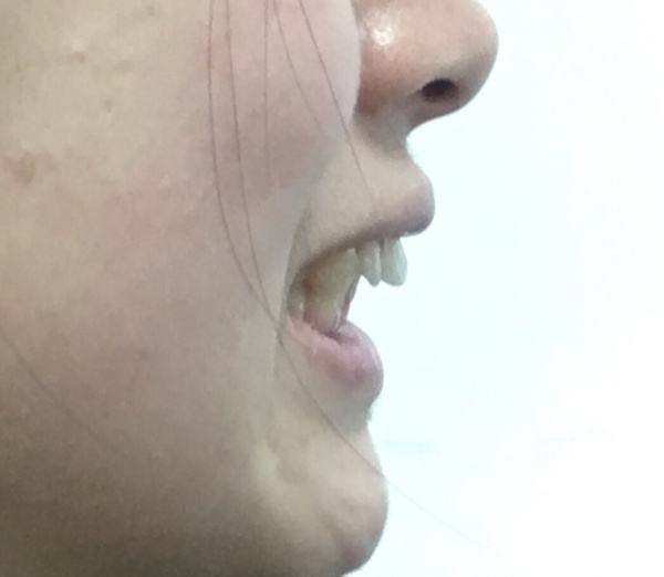 父母必看孩子教育,父母换牙需要关注什么