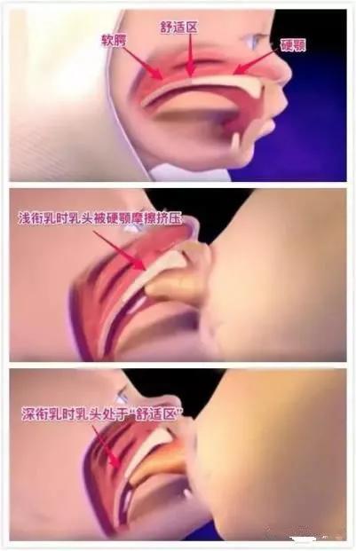 哺乳期乳房裂伤怎么办,乳房裂伤怎么办