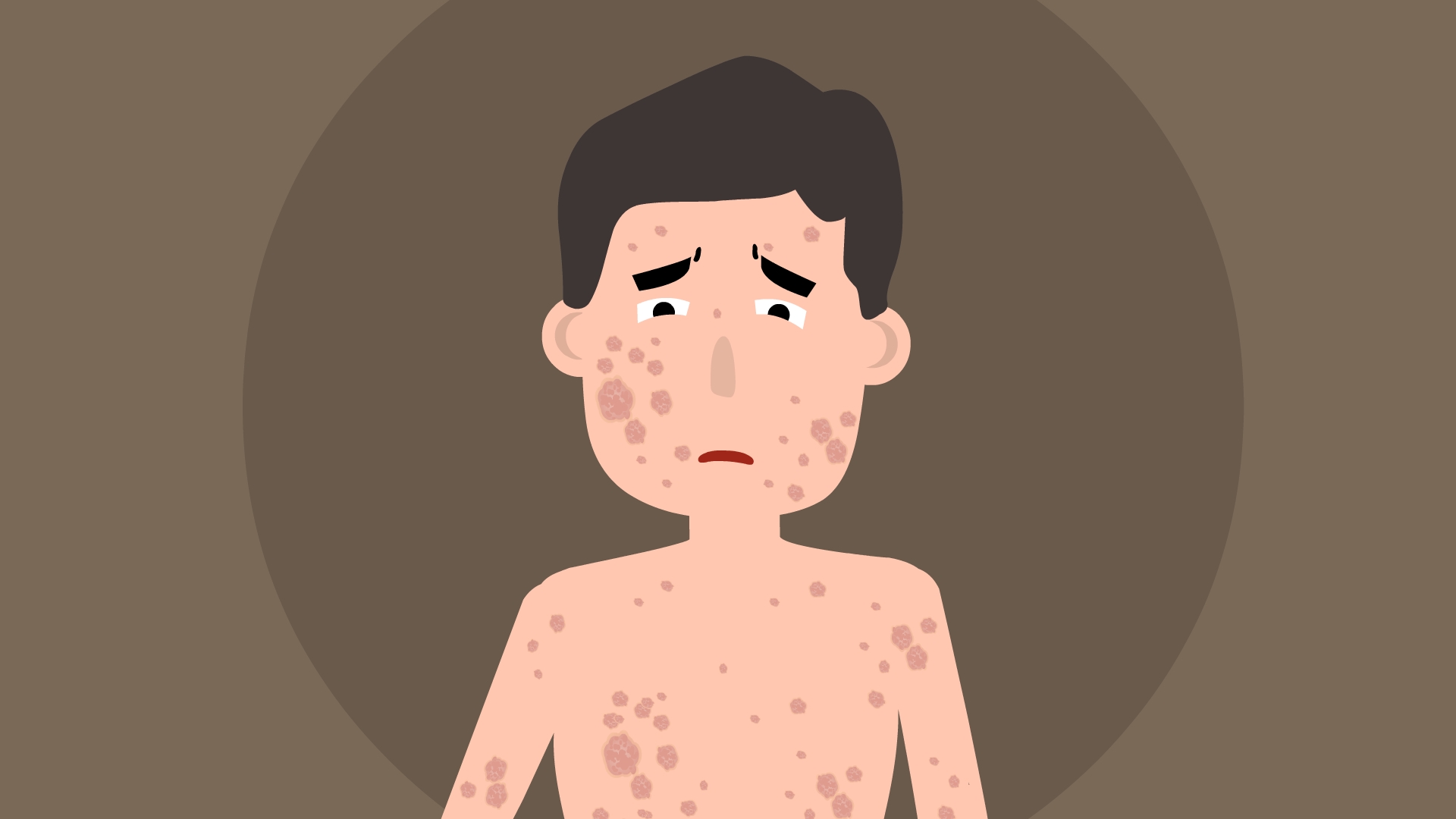 肿瘤来源于皮肤附属器是什么意思,皮肤附属器源性肿瘤能治好吗