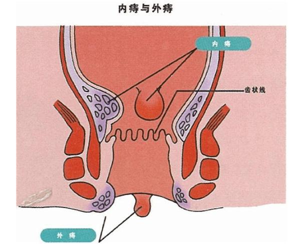 痔疮疼痛是不是熬夜熬得太晚了,30年的痔疮又犯病了