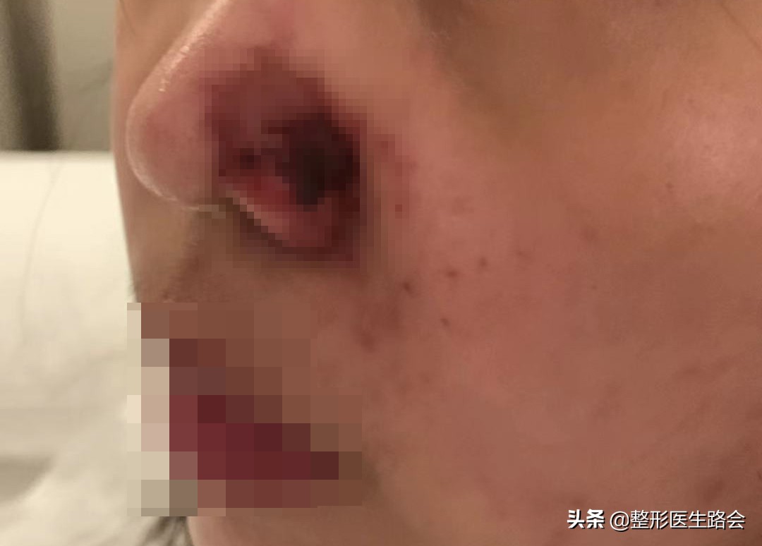 玻尿酸填充鼻子后悔了,玻尿酸注射后悔打溶解酶会不好吗