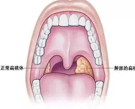儿童扁桃体炎带你了解究竟！