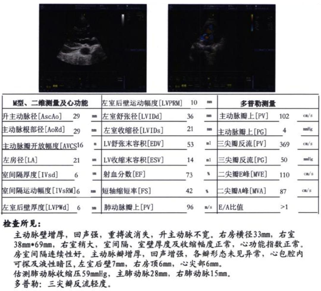 肺动脉高压患者咳嗽有血去哪治疗,肺动脉高压患者能进行呼吸康复吗