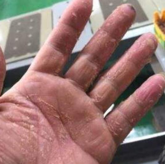 7岁孩子手指上换季脱皮,手指脱皮是身体求救信号