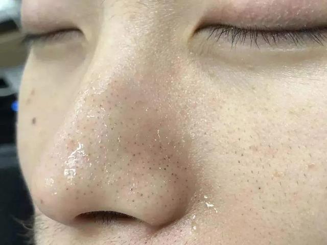 oes超声波吸黑头神器,吸黑头神器的正确使用方法