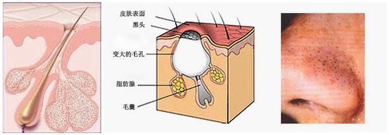 如何快速疏通毛孔清理皮肤垃圾,油性皮肤毛孔粗大怎么收缩毛孔