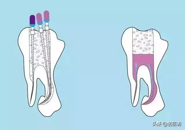 根管治疗戴冠后里面的牙还会烂吗,根管治疗戴冠后一周出现疼痛