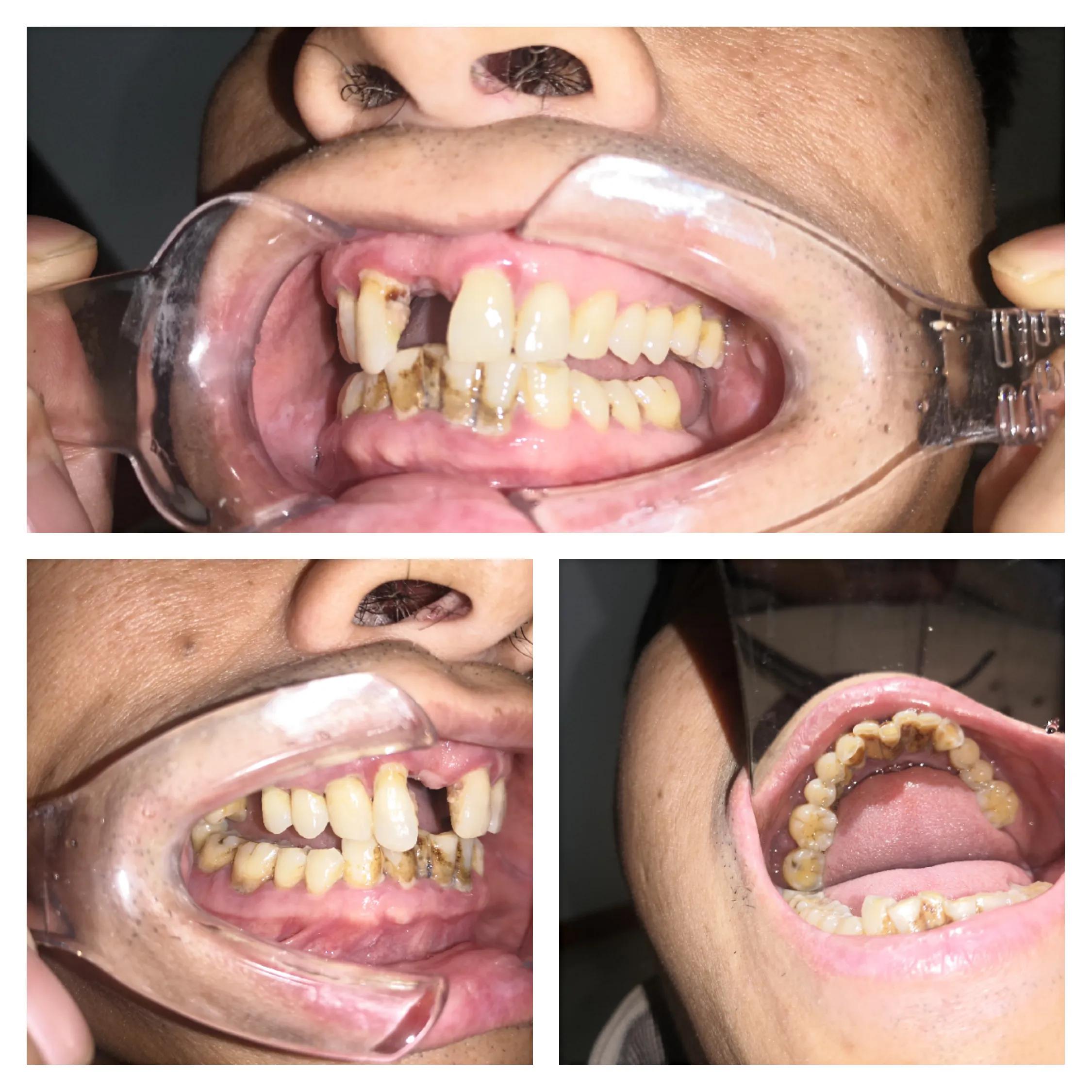 口腔卫生保健讲座第三讲牙菌斑及牙结石