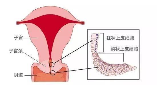 有宫颈糜烂慢性炎症容易生女孩吗,宫颈糜烂未生育的女性会得吗