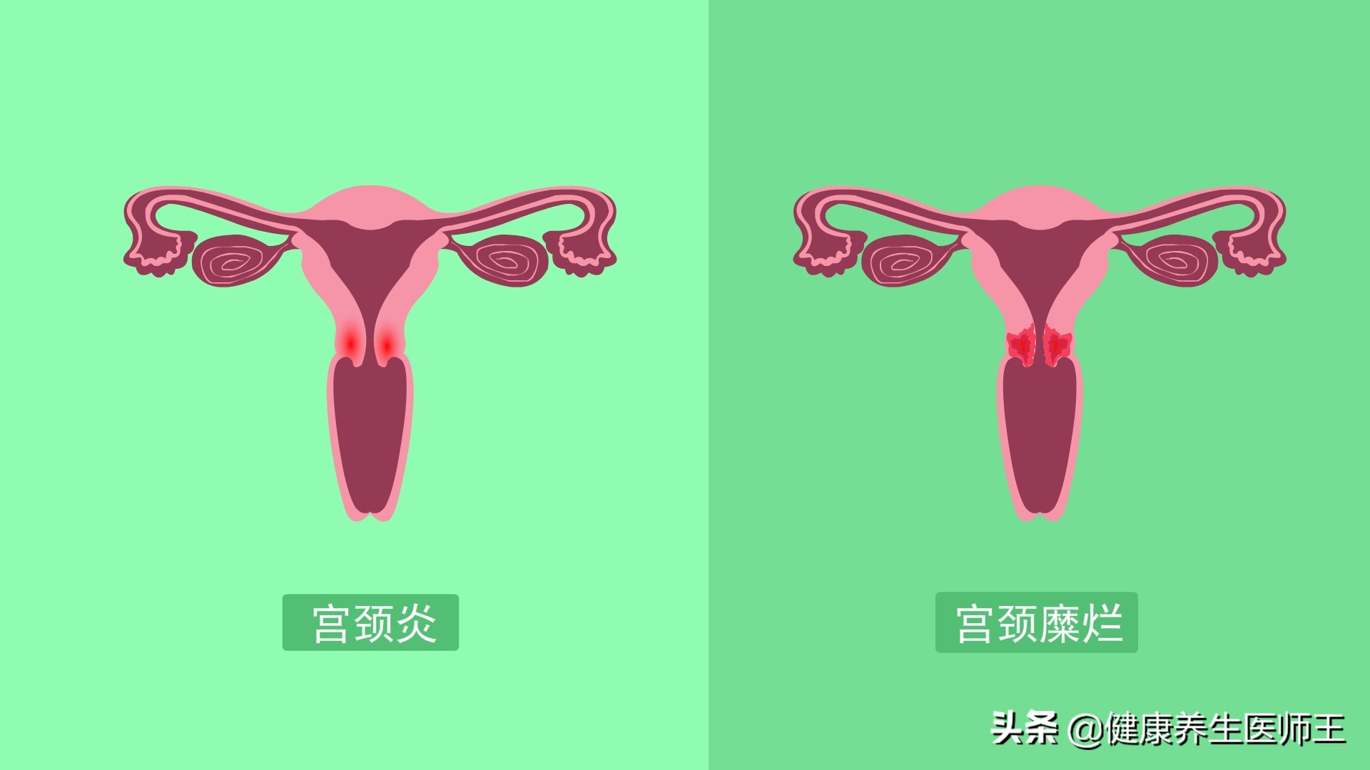 人体健康之急性子宫颈炎