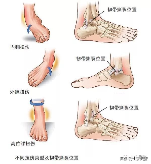 跑步单腿痛怎么解决,初学者跑步腿痛怎么办呢