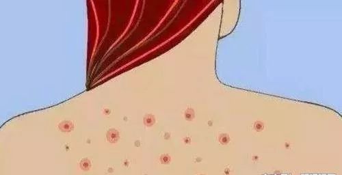 螨虫致痘？！螨虫究竟怎么办？今天一次告诉你