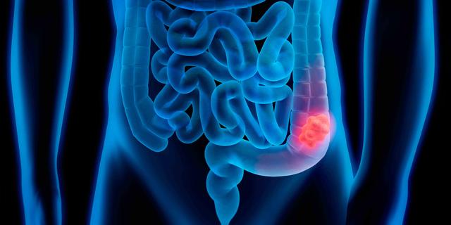 忽然间不“放屁”了，你的肠道可能遇到了。。*麻大**烦