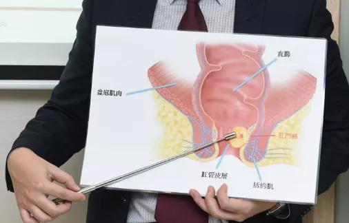 直肠癌与hpv感染有关么,hpv感染和脚气有关吗